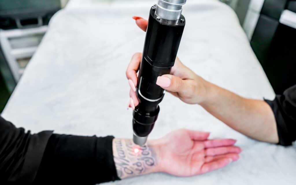 Laser, který odstraňuje tetování.